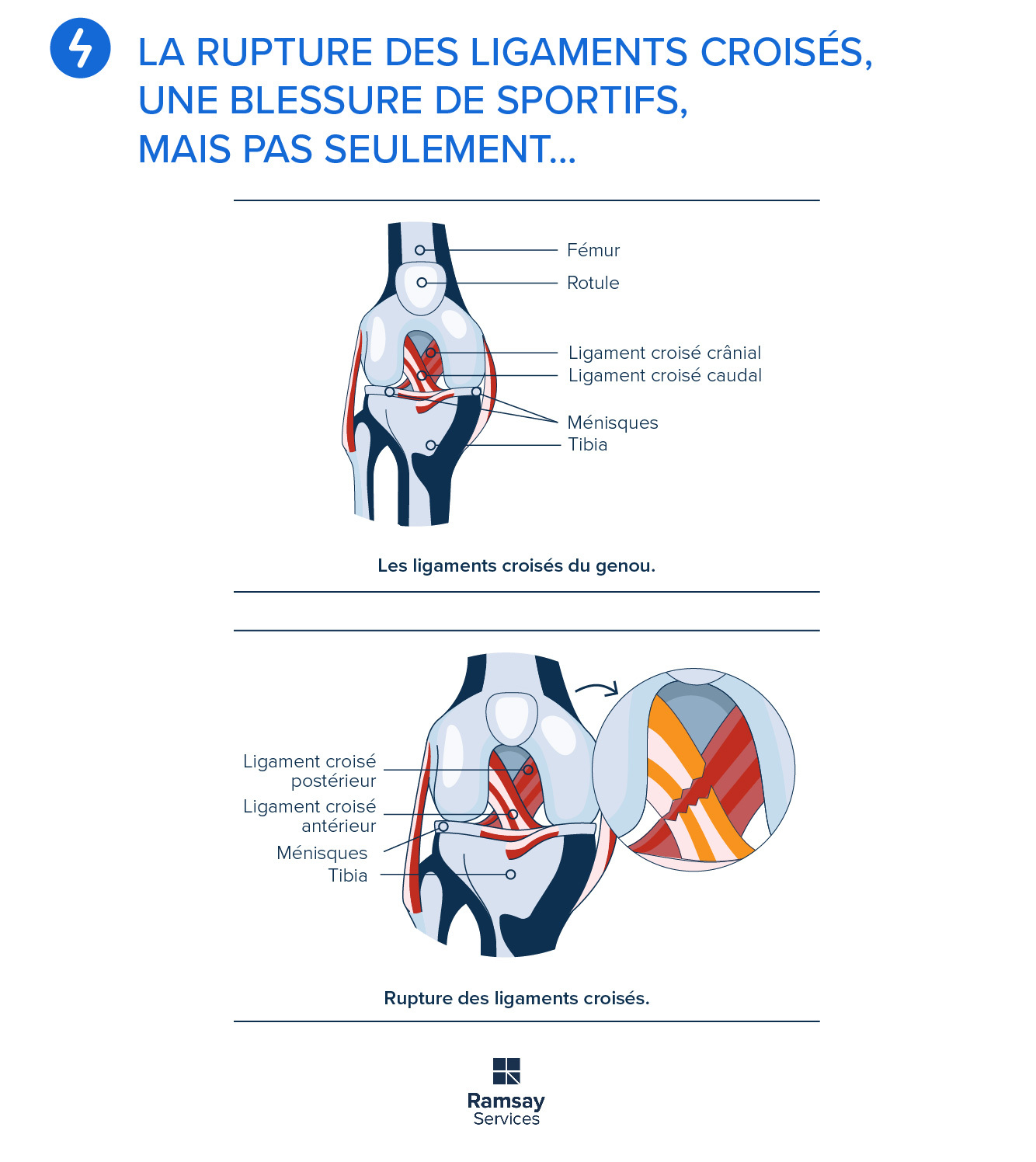 La rupture des ligaments croisés, une blessure de sportifs, mais pas — free download